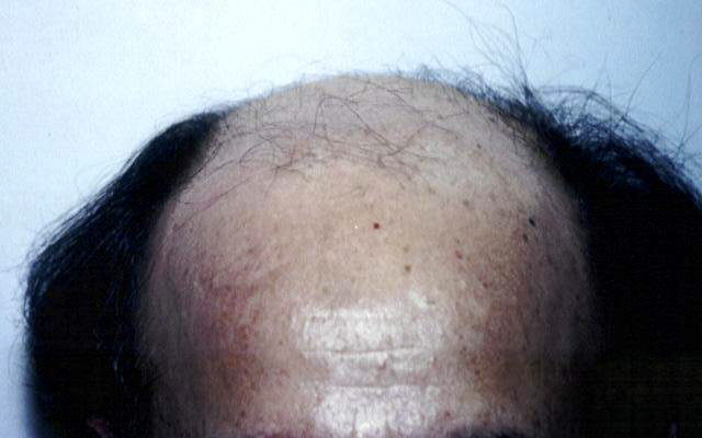 Dr Tavoussi Newport Beach Hair Transplant Surgery Orange