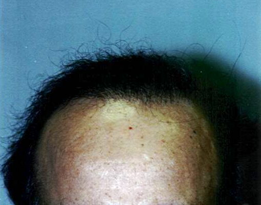 Dr Tavoussi Newport Beach Hair Transplant Surgery Orange